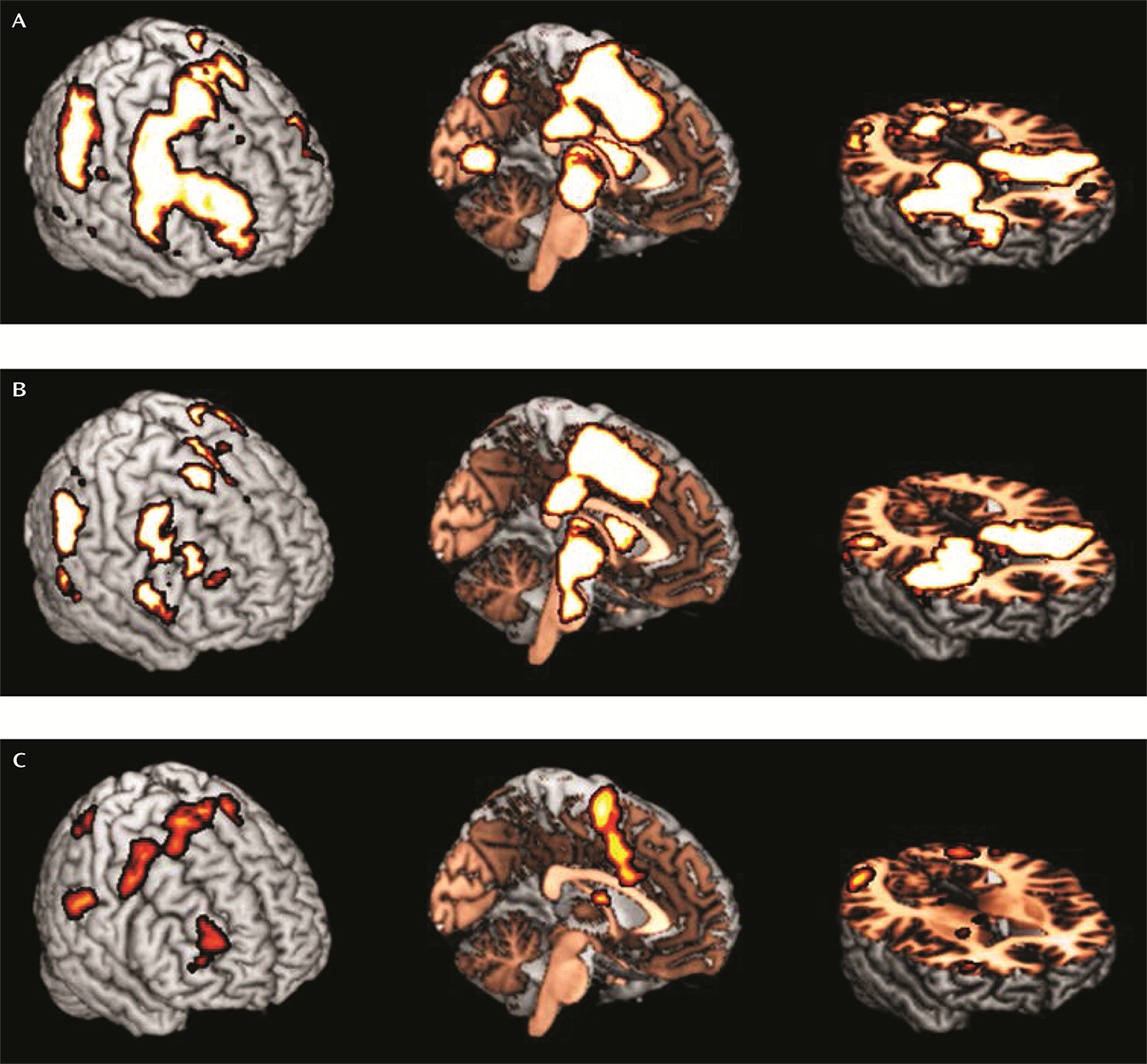 Thalamo-Cortical Activation and Connectivity During Response Preparation in Adults With Persistent and Remitted ADHD